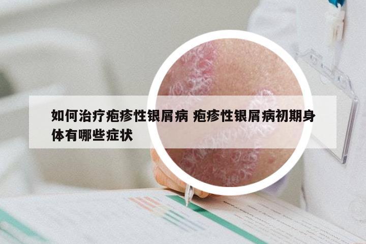 如何治疗疱疹性银屑病 疱疹性银屑病初期身体有哪些症状