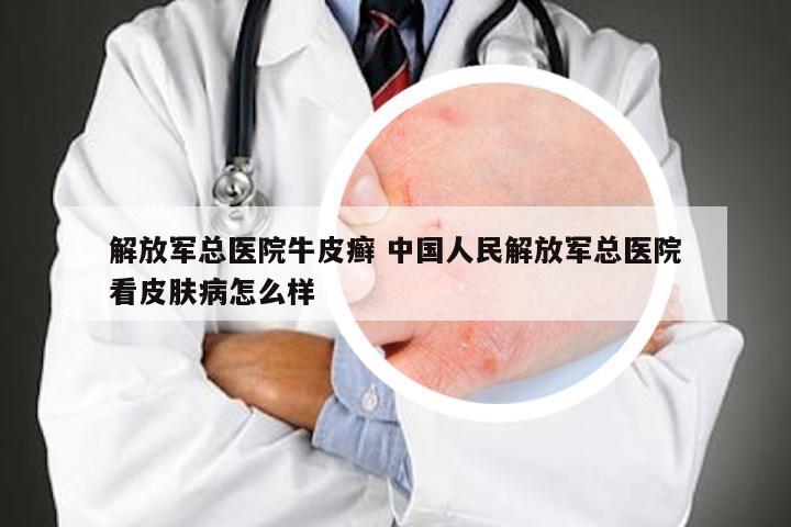 解放军总医院牛皮癣 中国人民解放军总医院看皮肤病怎么样