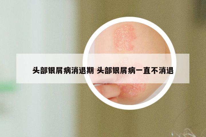 头部银屑病消退期 头部银屑病一直不消退