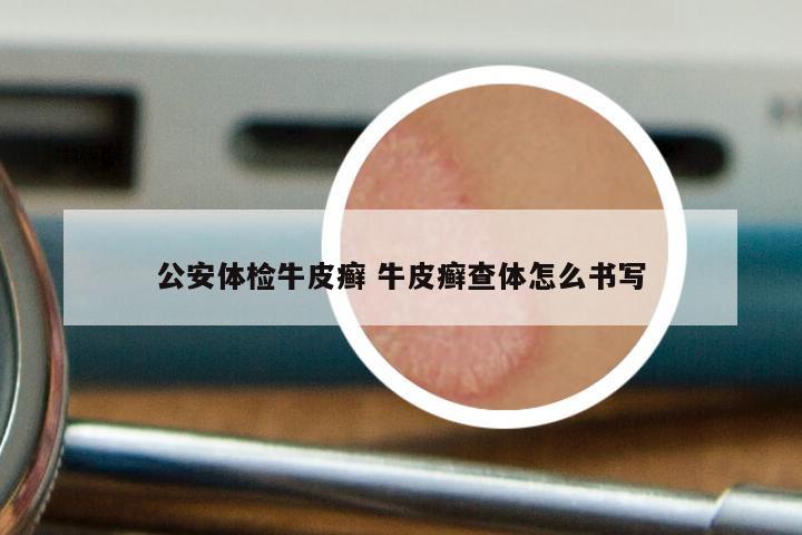 公安体检牛皮癣 牛皮癣查体怎么书写