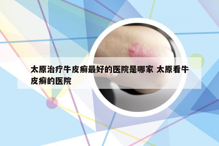 太原治疗牛皮癣最好的医院是哪家 太原看牛皮癣的医院