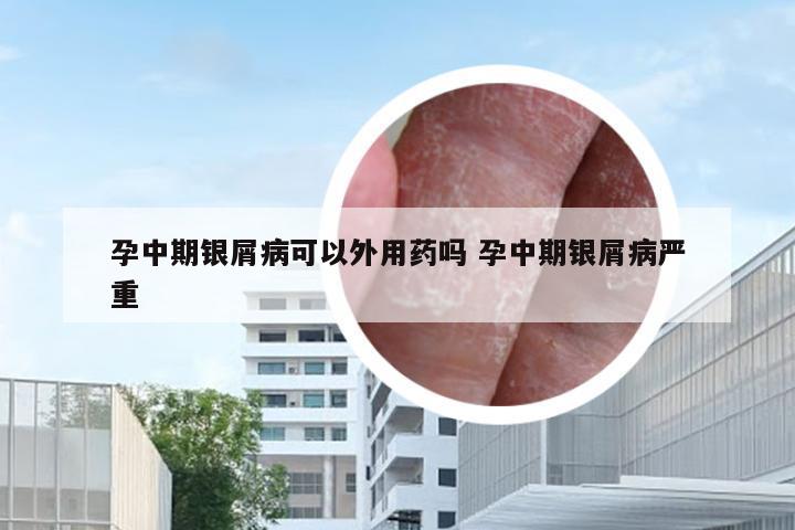 孕中期银屑病可以外用药吗 孕中期银屑病严重