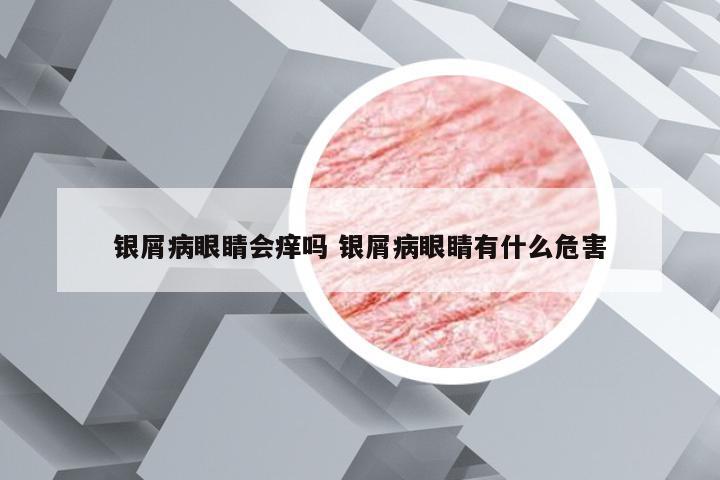 银屑病眼睛会痒吗 银屑病眼睛有什么危害