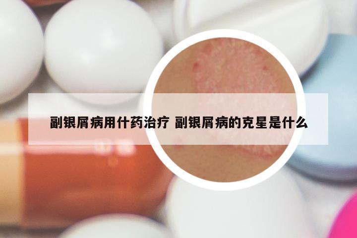 副银屑病用什药治疗 副银屑病的克星是什么