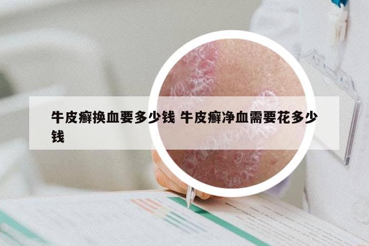 牛皮癣换血要多少钱 牛皮癣净血需要花多少钱