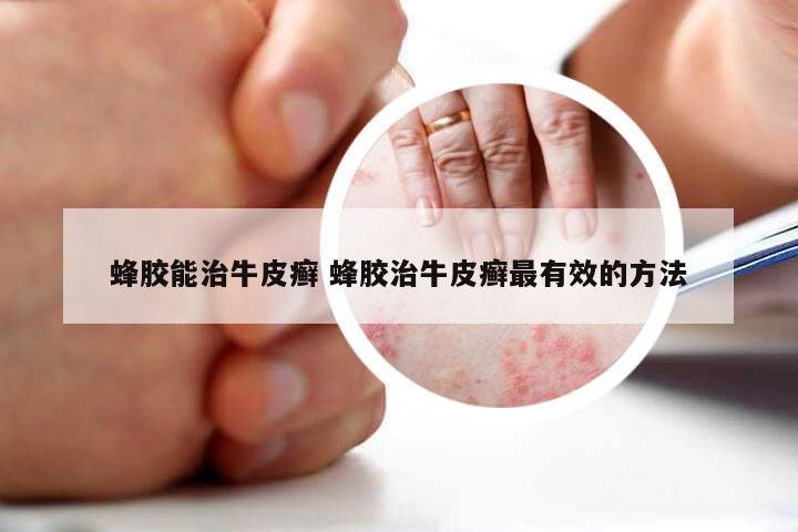 蜂胶能治牛皮癣 蜂胶治牛皮癣最有效的方法