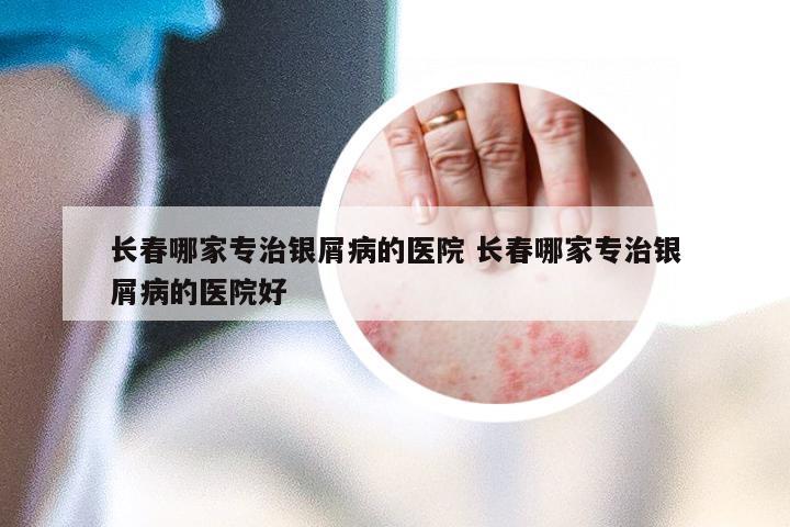 长春哪家专治银屑病的医院 长春哪家专治银屑病的医院好