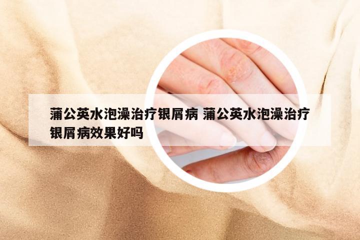 蒲公英水泡澡治疗银屑病 蒲公英水泡澡治疗银屑病效果好吗