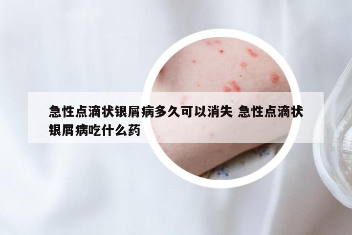 急性点滴状银屑病多久可以消失 急性点滴状银屑病吃什么药