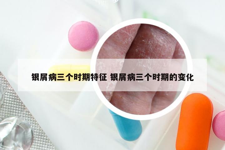 银屑病三个时期特征 银屑病三个时期的变化