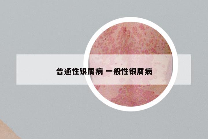 普通性银屑病 一般性银屑病