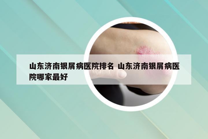 山东济南银屑病医院排名 山东济南银屑病医院哪家最好