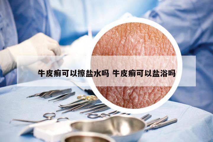 牛皮癣可以擦盐水吗 牛皮癣可以盐浴吗