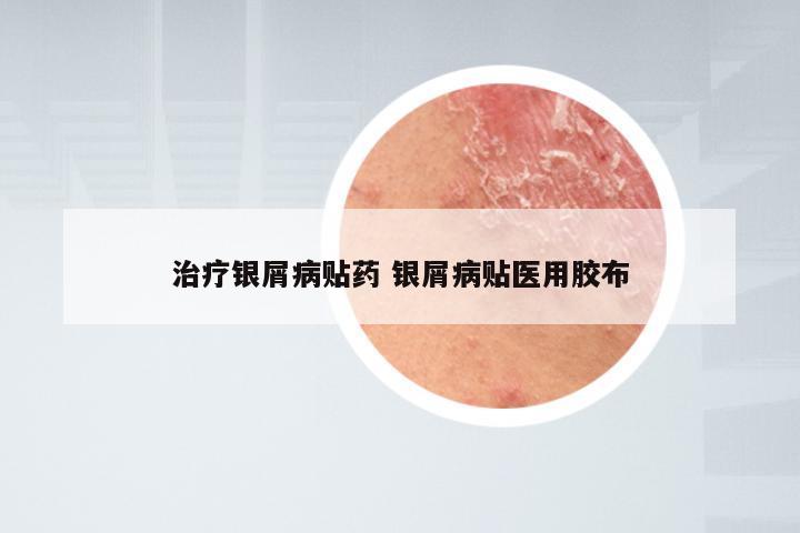 治疗银屑病贴药 银屑病贴医用胶布