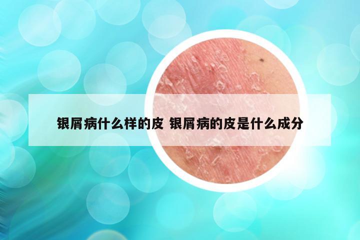 银屑病什么样的皮 银屑病的皮是什么成分