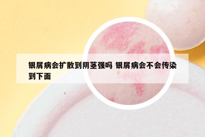 银屑病会扩散到阴茎强吗 银屑病会不会传染到下面