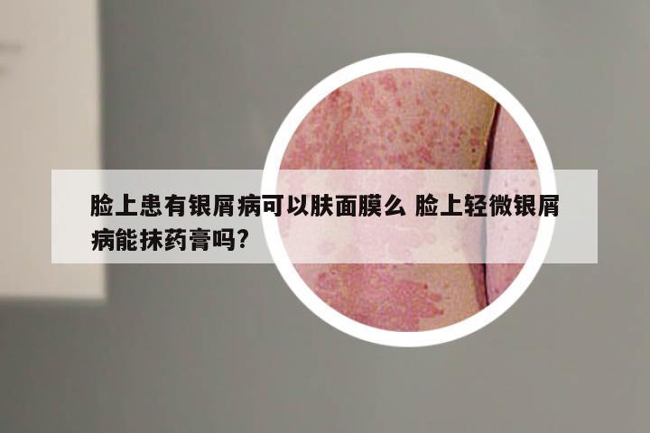 脸上患有银屑病可以肤面膜么 脸上轻微银屑病能抹药膏吗?