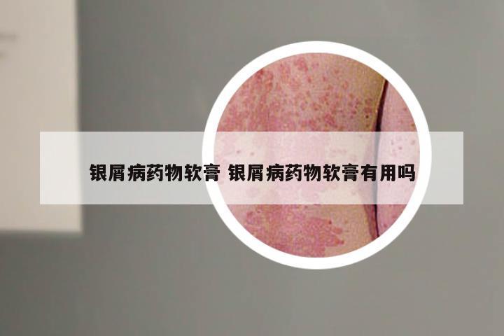 银屑病药物软膏 银屑病药物软膏有用吗