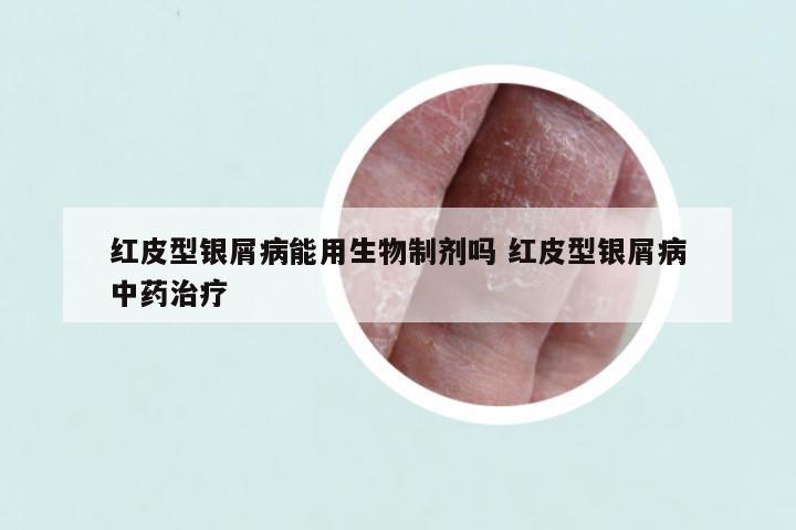 红皮型银屑病能用生物制剂吗 红皮型银屑病中药治疗