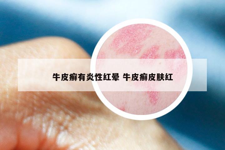 牛皮癣有炎性红晕 牛皮癣皮肤红
