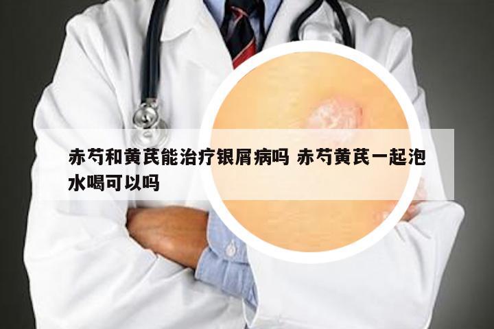 赤芍和黄芪能治疗银屑病吗 赤芍黄芪一起泡水喝可以吗