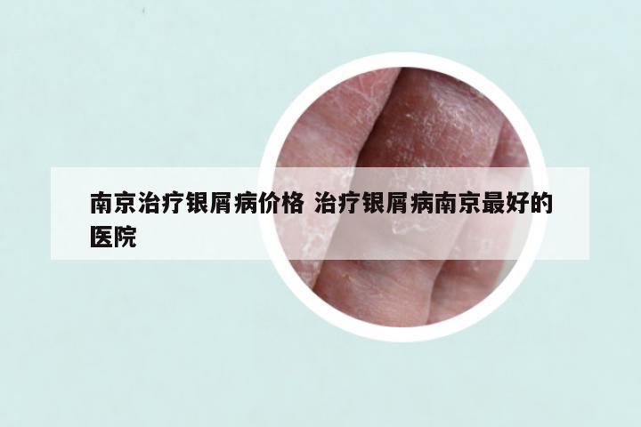 南京治疗银屑病价格 治疗银屑病南京最好的医院