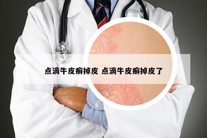 点滴牛皮癣掉皮 点滴牛皮癣掉皮了