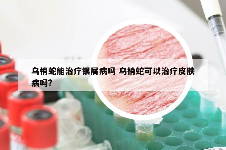 乌梢蛇能治疗银屑病吗 乌梢蛇可以治疗皮肤病吗?