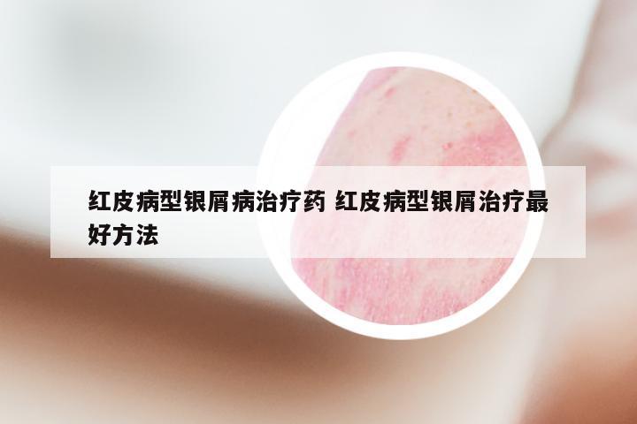 红皮病型银屑病治疗药 红皮病型银屑治疗最好方法