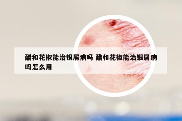 醋和花椒能治银屑病吗 醋和花椒能治银屑病吗怎么用
