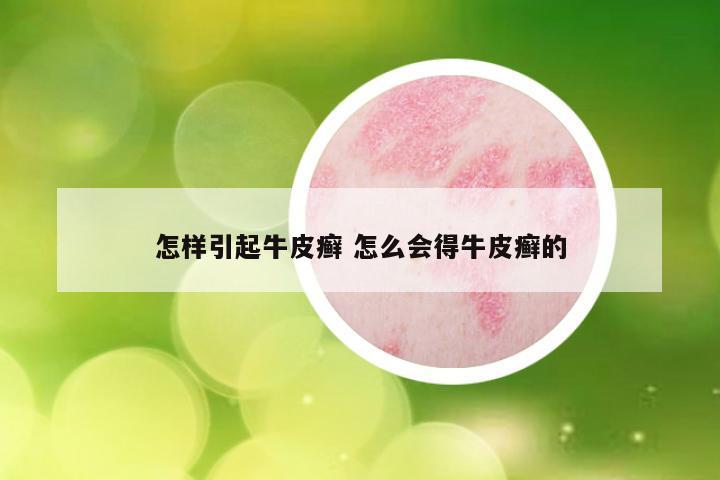 怎样引起牛皮癣 怎么会得牛皮癣的