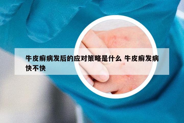 牛皮癣病发后的应对策略是什么 牛皮癣发病快不快