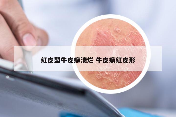 红皮型牛皮癣溃烂 牛皮癣红皮形