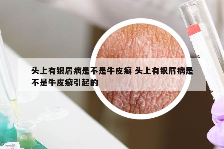 头上有银屑病是不是牛皮癣 头上有银屑病是不是牛皮癣引起的