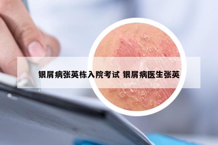 银屑病张英栋入院考试 银屑病医生张英