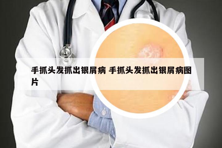 手抓头发抓出银屑病 手抓头发抓出银屑病图片
