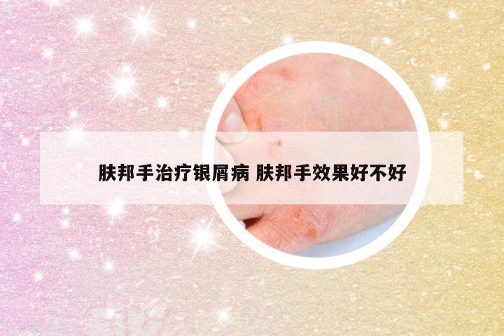 肤邦手治疗银屑病 肤邦手效果好不好