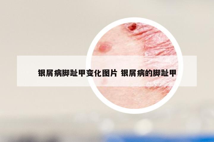 银屑病脚趾甲变化图片 银屑病的脚趾甲