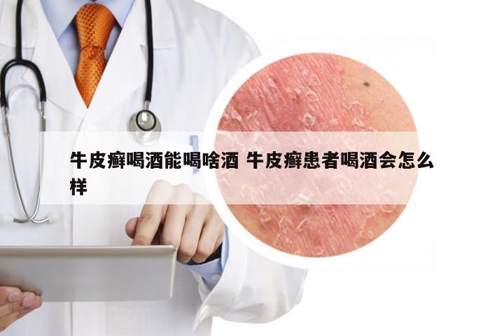牛皮癣喝酒能喝啥酒 牛皮癣患者喝酒会怎么样