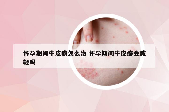 怀孕期间牛皮癣怎么治 怀孕期间牛皮癣会减轻吗