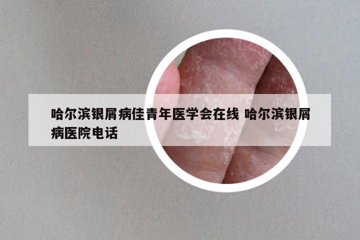 哈尔滨银屑病佳青年医学会在线 哈尔滨银屑病医院电话