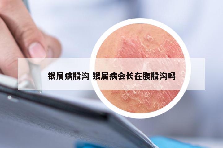 银屑病股沟 银屑病会长在腹股沟吗