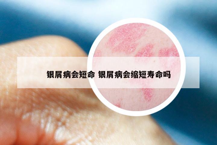 银屑病会短命 银屑病会缩短寿命吗