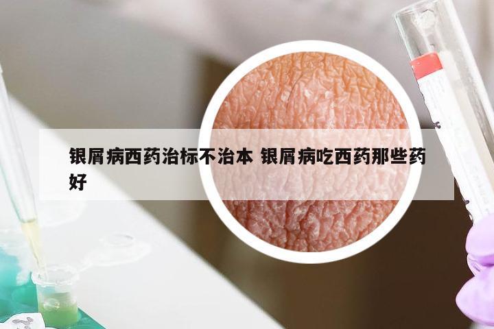 银屑病西药治标不治本 银屑病吃西药那些药好