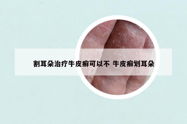 割耳朵治疗牛皮癣可以不 牛皮癣划耳朵