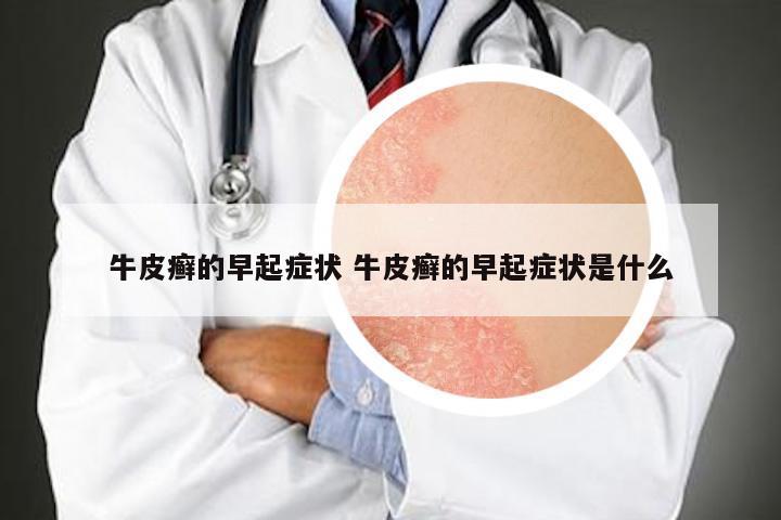 牛皮癣的早起症状 牛皮癣的早起症状是什么