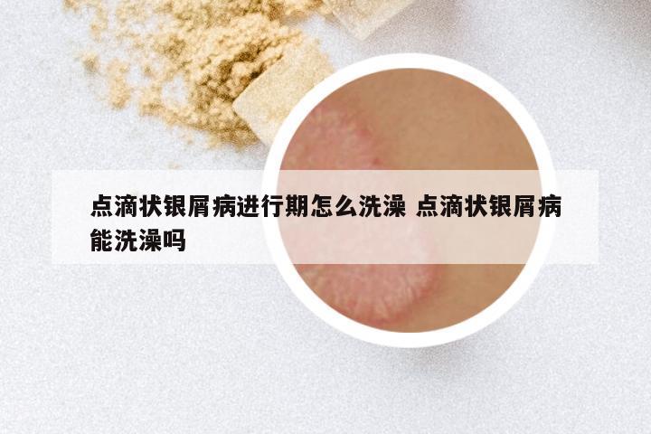 点滴状银屑病进行期怎么洗澡 点滴状银屑病能洗澡吗