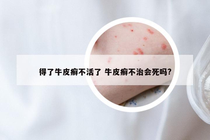 得了牛皮癣不活了 牛皮癣不治会死吗?
