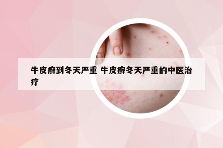 牛皮癣到冬天严重 牛皮癣冬天严重的中医治疗