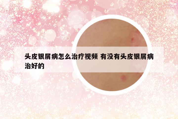 头皮银屑病怎么治疗视频 有没有头皮银屑病治好的
